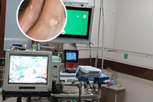 黑色素移植要忌口多久