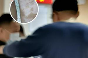 他克莫司軟膏越涂越紅越癢