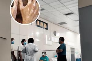 魯索替尼白癜風(fēng)