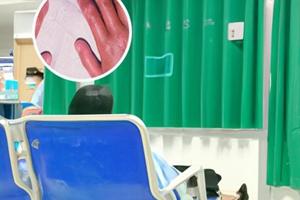 苯海拉明治療美尼爾綜合癥